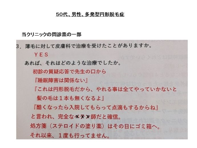 円形脱毛症　病院